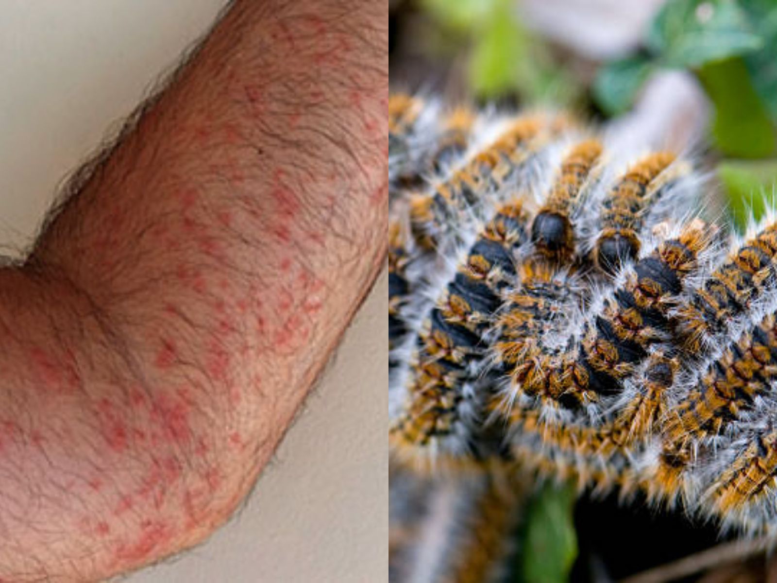 δερματίτιδα-από-κάμπιες-αντιμετώπιση-συμπτώματα-