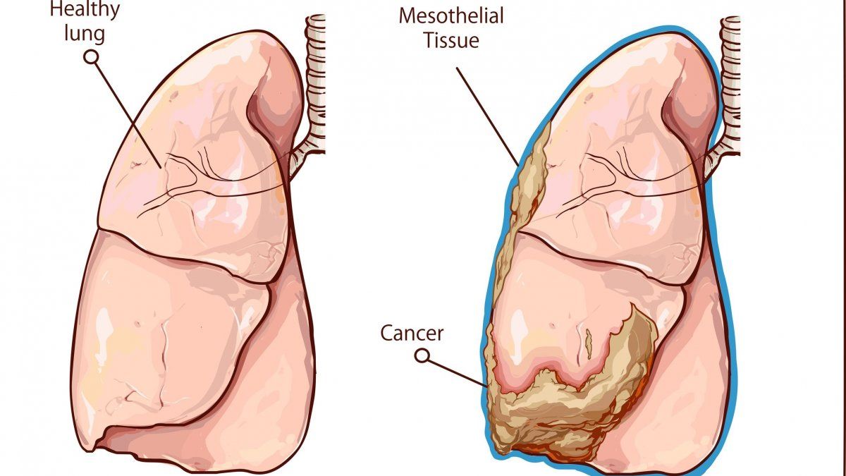 Μεσοθηλίωμα : Τα συμπτώματα του εξαιρετικά επικίνδυνου και επιθετικού καρκίνου