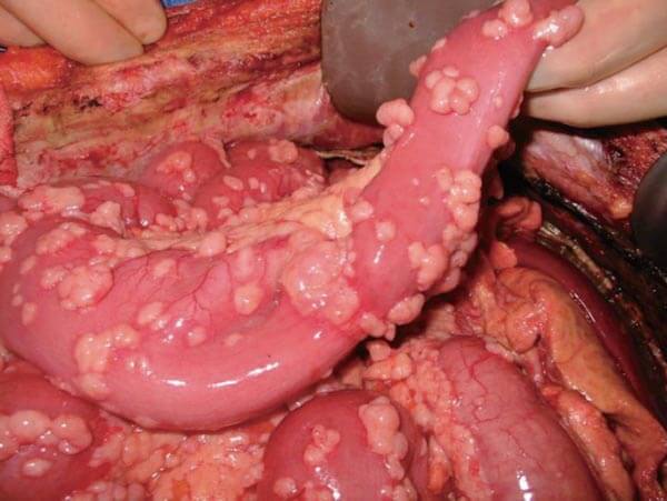 Μεσοθηλίωμα : Τα συμπτώματα του εξαιρετικά επικίνδυνου και επιθετικού καρκίνου