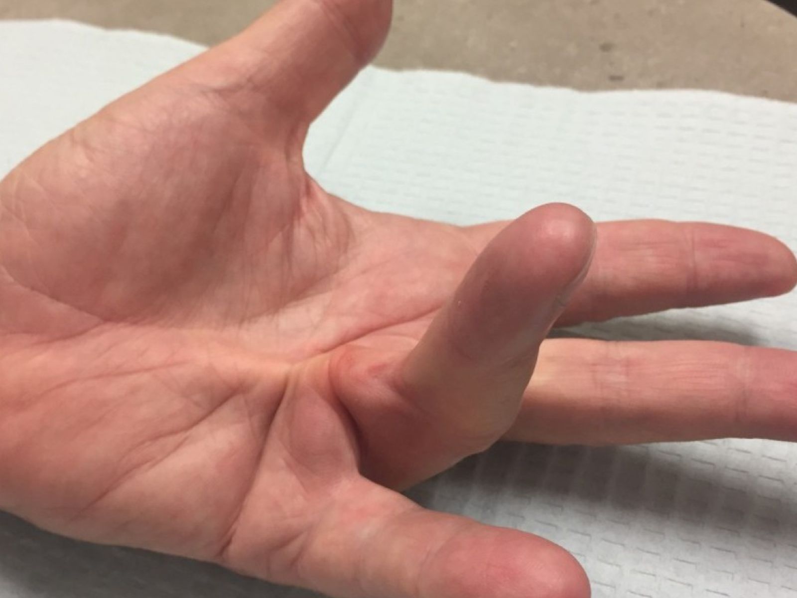 Αγκύλωση Δακτύλων Χεριού: Τα προβλήματα υγείας που μπορεί να υποδηλώνονται και η αντιμετώπιση