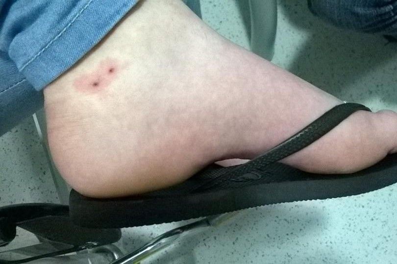 Τσίμπημα από φίδι: Οι πρώτες βοήθειες μέχρι να φτάσεις στο νοσοκομείο