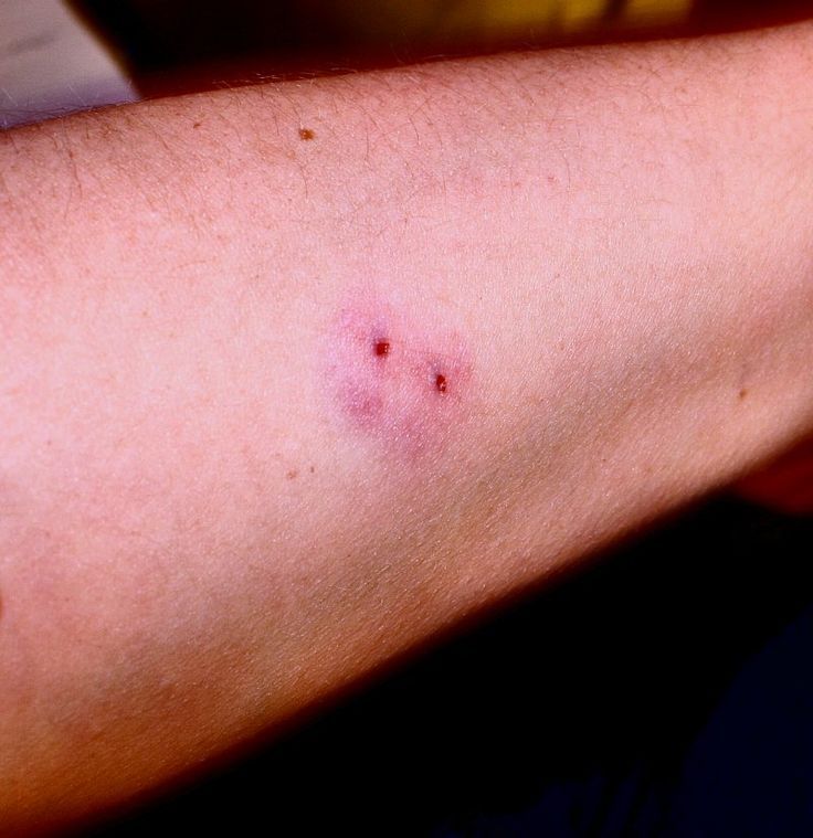 Τσίμπημα από φίδι: Οι πρώτες βοήθειες μέχρι να φτάσεις στο νοσοκομείο