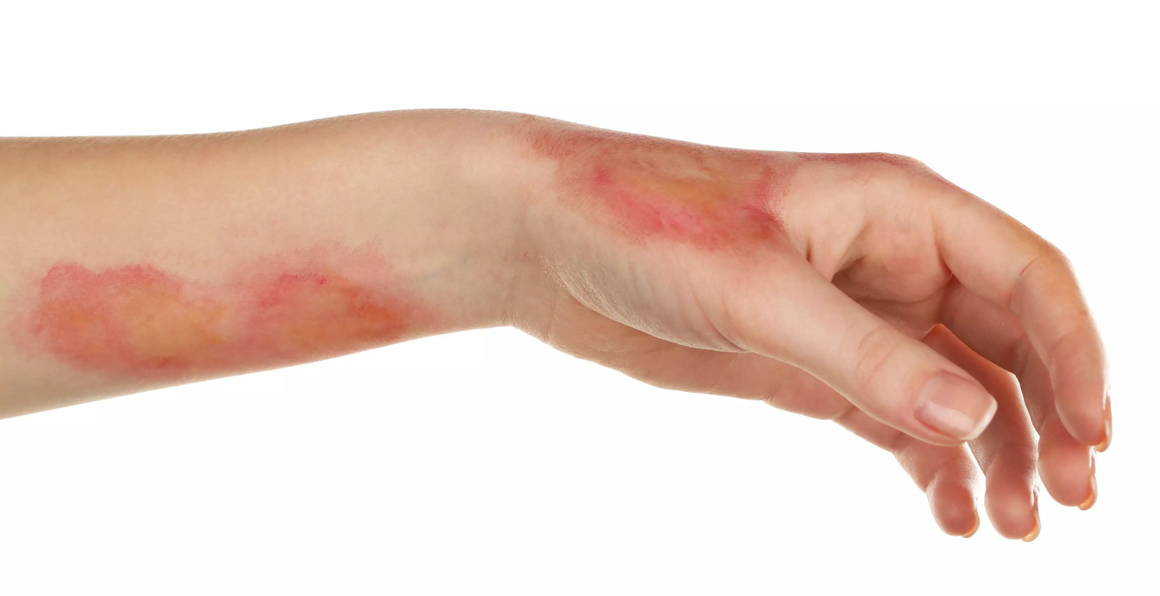 Εγκαύματα από λαμπάδα, σούβλα, κροτίδες και βεγγαλικά – Οι πρώτες βοήθειες για τα πιο συχνά ατυχήματα του Πάσχα