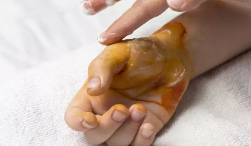 Εγκαύματα από λαμπάδα, σούβλα, κροτίδες και βεγγαλικά – Οι πρώτες βοήθειες για τα πιο συχνά ατυχήματα του Πάσχα