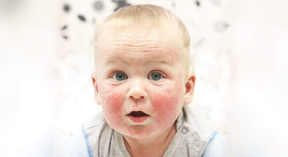 Αλλεργία στο αγελαδινό γάλα στα βρέφη: Συμπτώματα και συμβουλές αντιμετώπισης από παιδίατρο