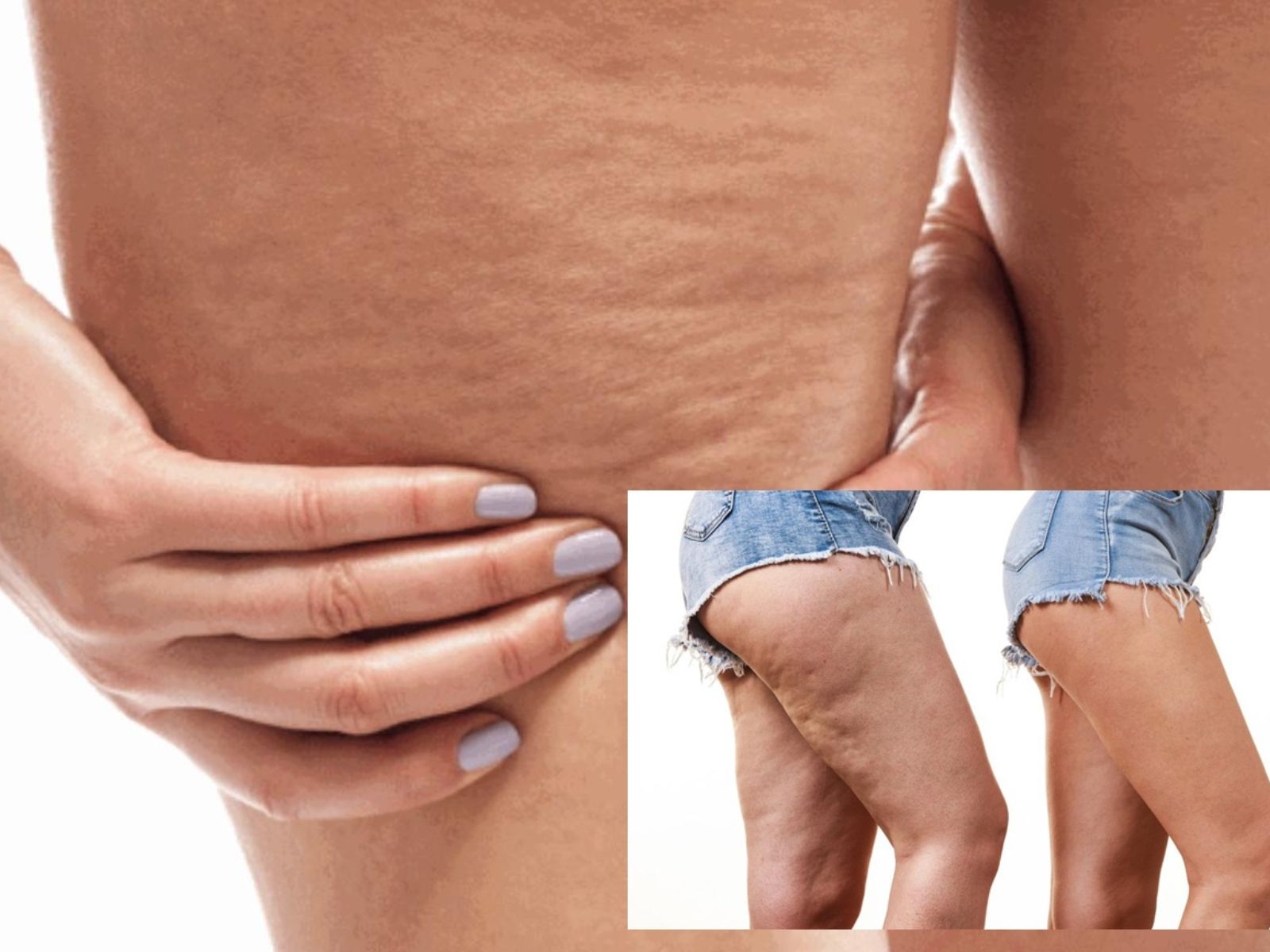 Η μαγική συνταγή με το 1 υλικό που θα σε κάνει να απαλλαγείς από την κυτταρίτιδα