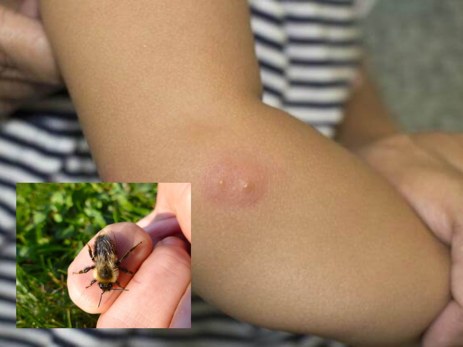 Τσίμπησε το παιδί μέλισσα ή σφήκα στην εξοχή – Πώς να αντιμετωπίσεις τα συμπτώματα μέχρι να πας στον γιατρό