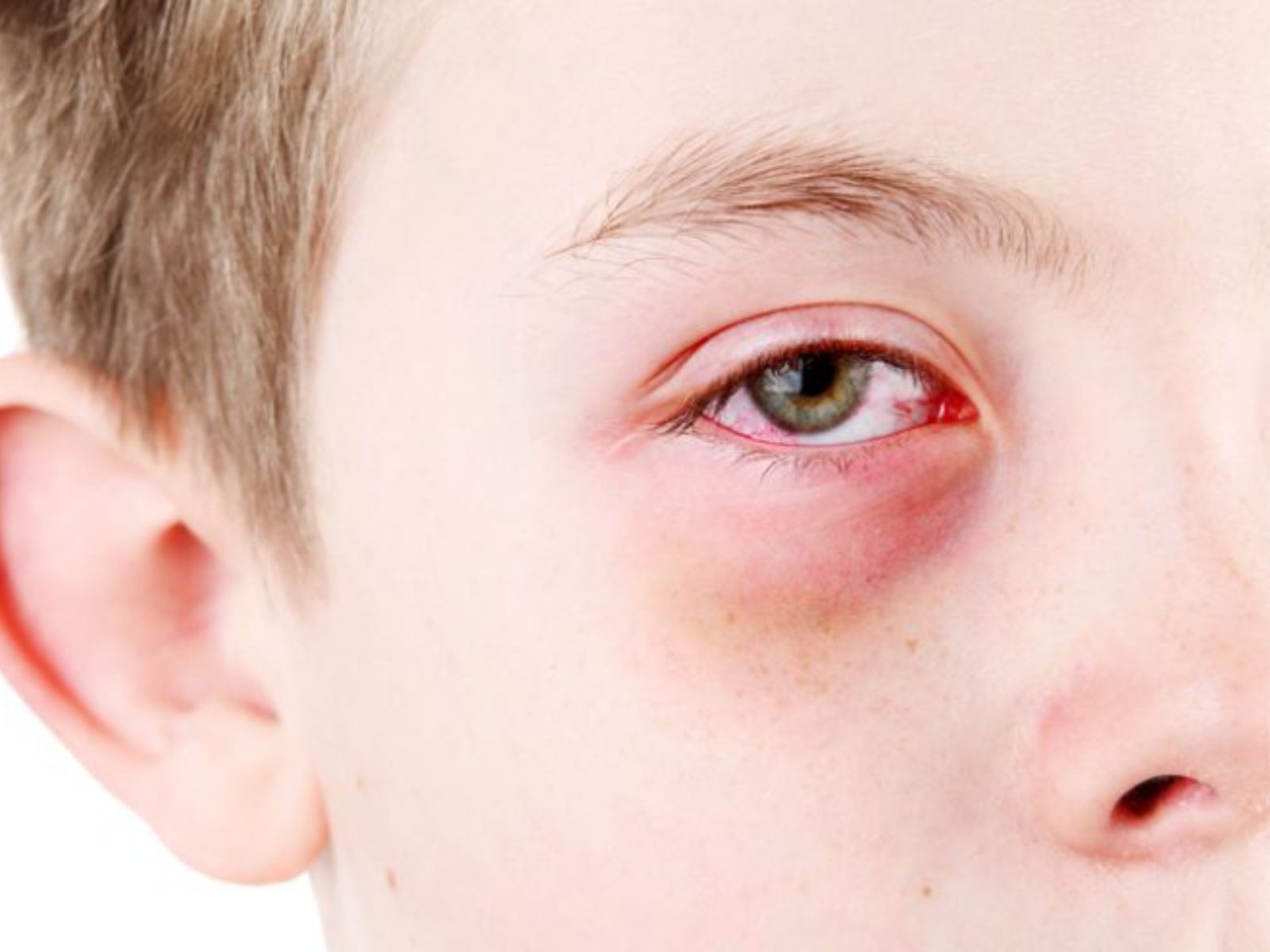 Γυαλιά σκόνη άμμος στα μάτια του παιδιού – Οι Πρώτες Βοήθειες σύμφωνα με παιδίατρο