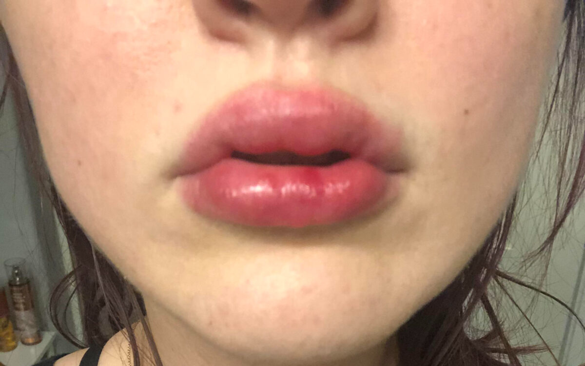 Filler fatigue: H εξάντληση από υαλουρονικo οξύ - Παρενέργειες & Συμβουλές από Πλαστικό Χειρουργό