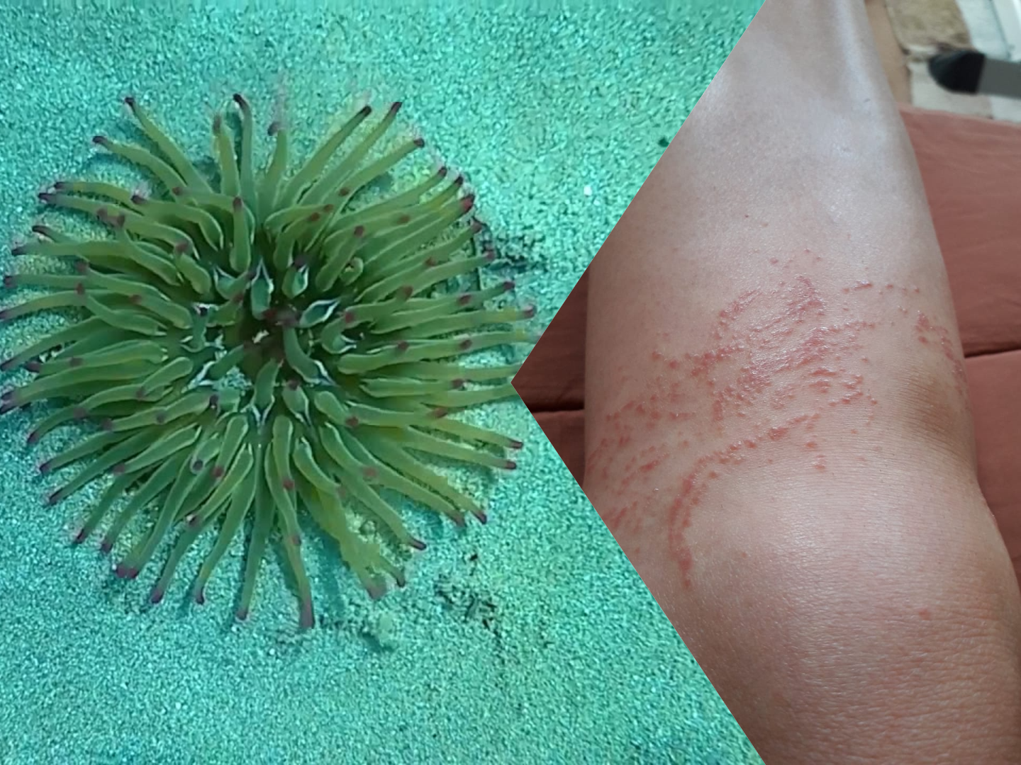 Δύο παιδιά μεταφέρθηκαν εσπευσμένα στο νοσοκομείο από τσίμπημα ανεμώνης- Όλα όσα πρέπει να προσέξετε