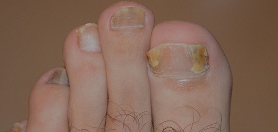 Γιατί τα πόδια μυρίζουν πιο πολύ το Καλοκαίρι (και πώς να το σταματήσεις)