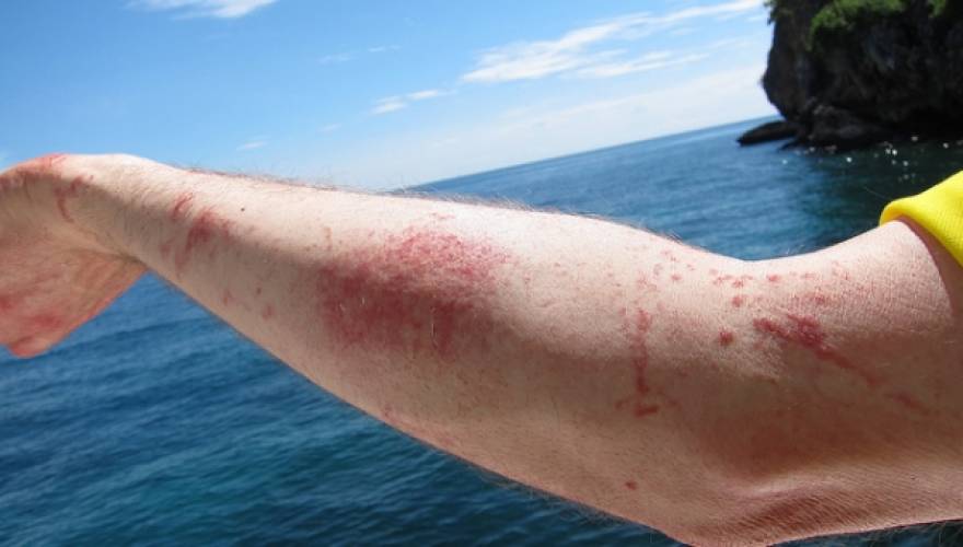 Μύθοι και αλήθειες για τις τσούχτρες — Πρέπει να βάλεις ξύδι ή όχι;