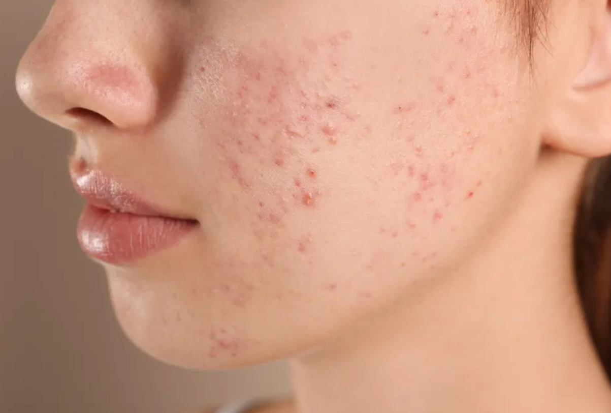 Κορυφαίες θεραπείες για την ακμή που λειτουργούν πραγματικά