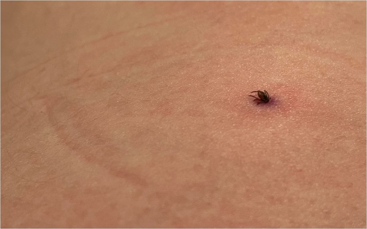 Αιμορραγικός πυρετός : Τα συμπτώματα και τί πρέπει να κάνετε αν σας τσιμπήσει τσιμπούρι