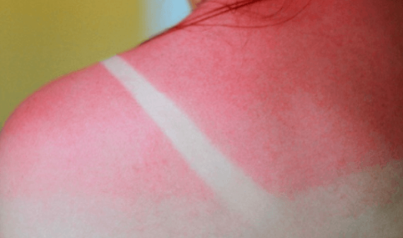 Τι πρέπει να ξέρεις για τις ηλιακά εγκαύματα — γρήγορη αντιμετώπιση στο σπίτι