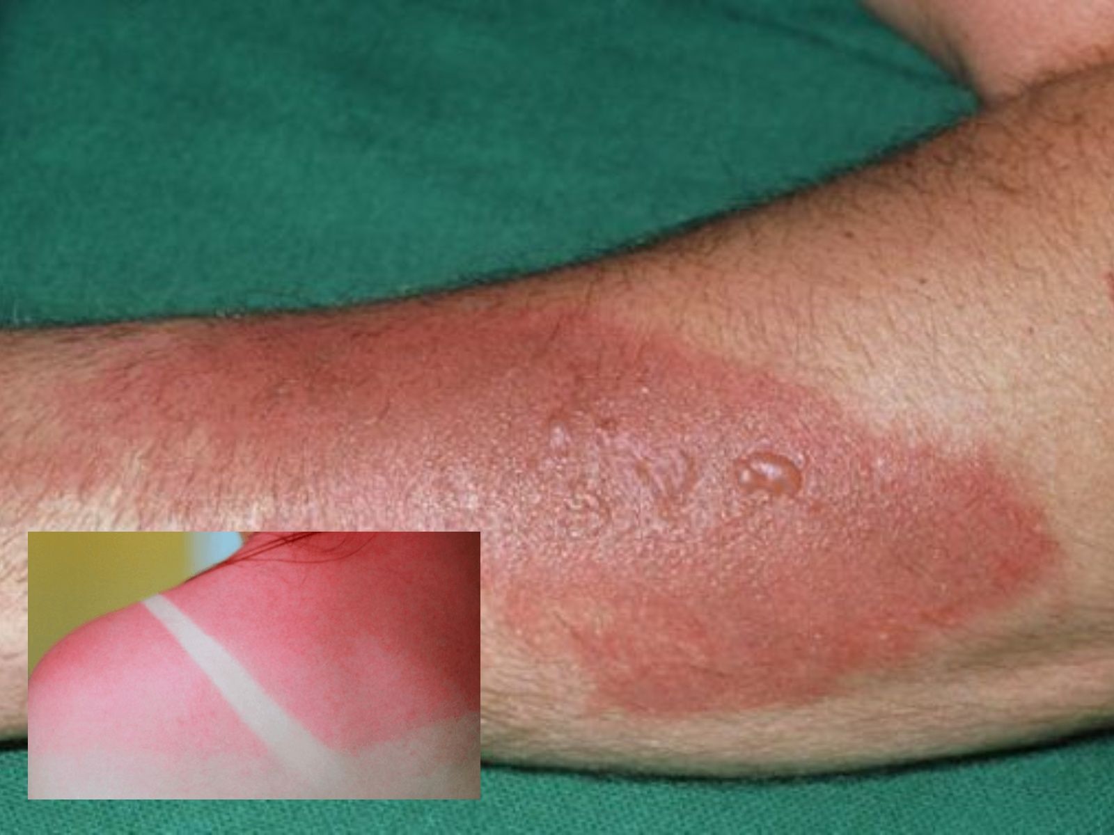 Τι πρέπει να ξέρεις για τις ηλιακά εγκαύματα — γρήγορη αντιμετώπιση στο σπίτι