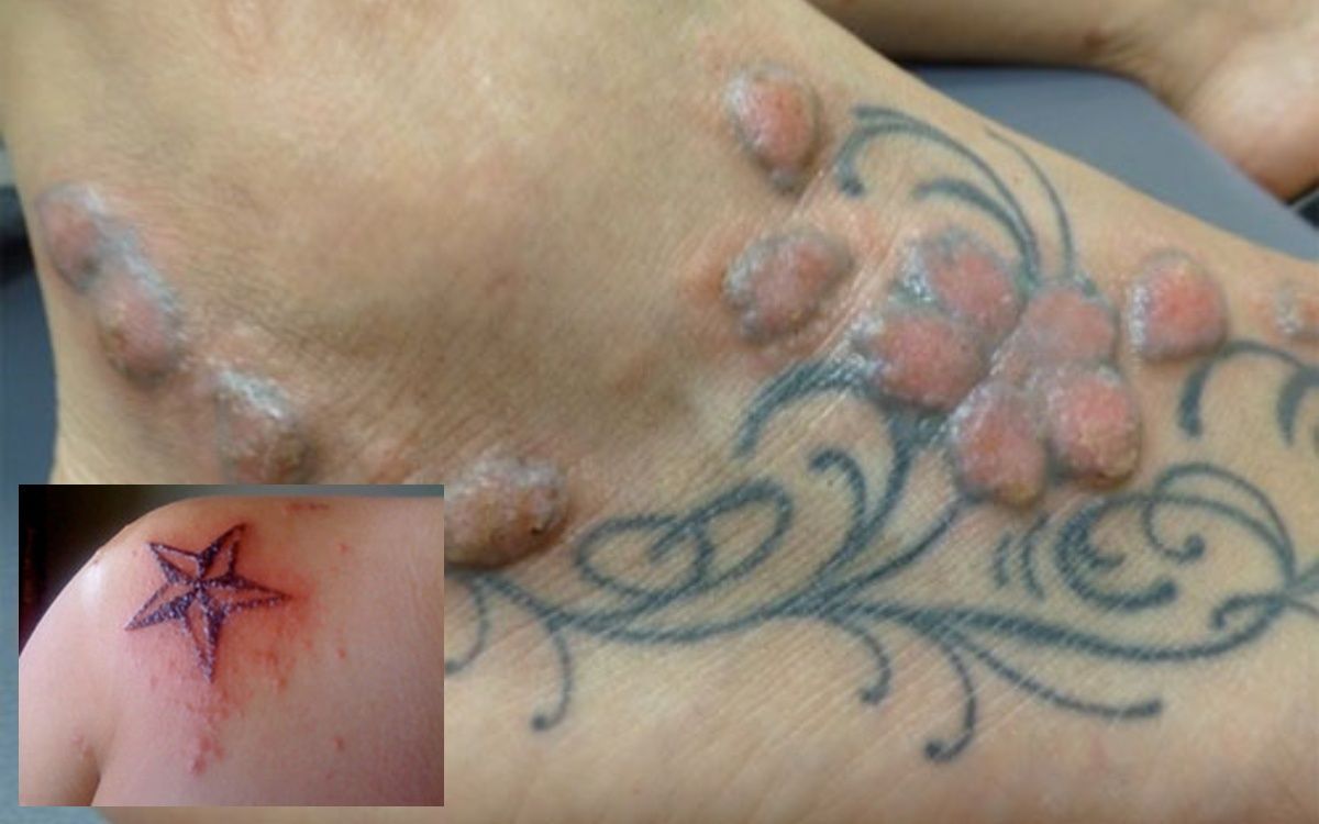 Γιατί απαγορεύεται να κάνετε τατουάζ το Καλοκαίρι και πως να το προστατεύσετε αν έχετε ήδη