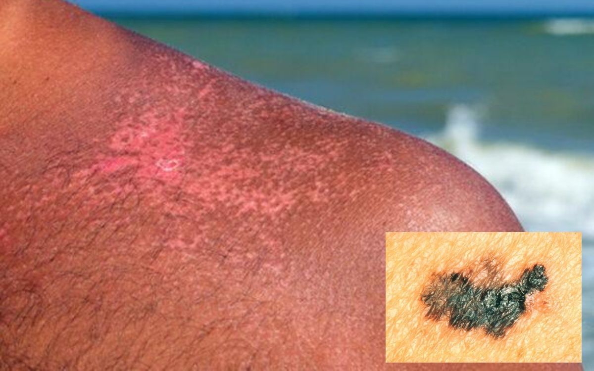 Καρκίνος του δέρματος - Τα ύπουλα συμπτώματα που πρέπει να μας χτυπήσουν καμπανάκι