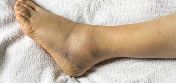 Κορτιζόνη - Οι παρενέργειες του φαρμάκου και σε ποιες περιπτώσεις χορηγείται