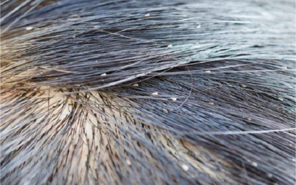 Νεκρό 12χρονο κορίτσι από ψείρες στο κεφάλι-  Έχουν συλληφθεί οι γονείς