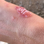 Πώς είναι το τσίμπημα από μοβ τσούχτρα φωτογραφίες και οι πρώτες βοήθειες