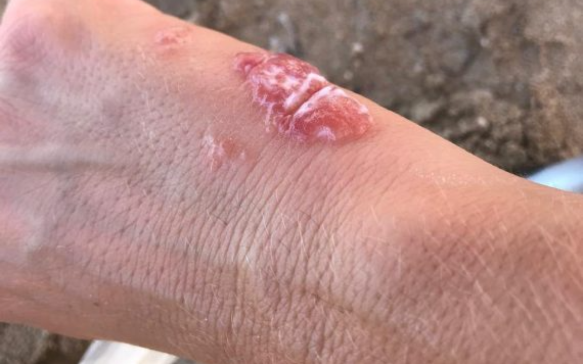 Πώς είναι το τσίμπημα από μοβ τσούχτρα φωτογραφίες και οι πρώτες βοήθειες