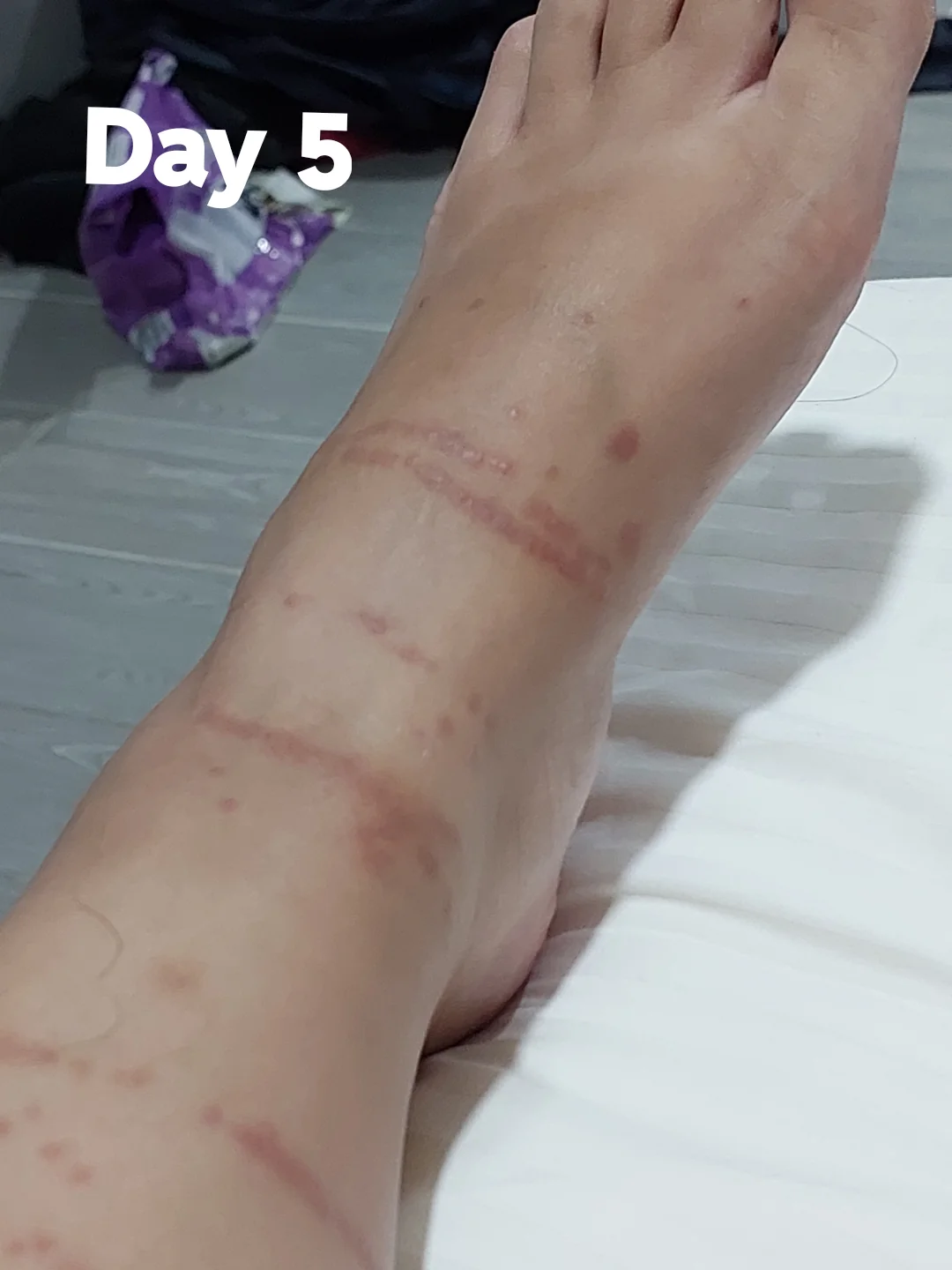 Τσίμπησε μωβ τσούχτρα το παιδί - Οδηγίες από Παιδίατρο και οι πρώτες βοήθειες που πρέπει να δώσεις