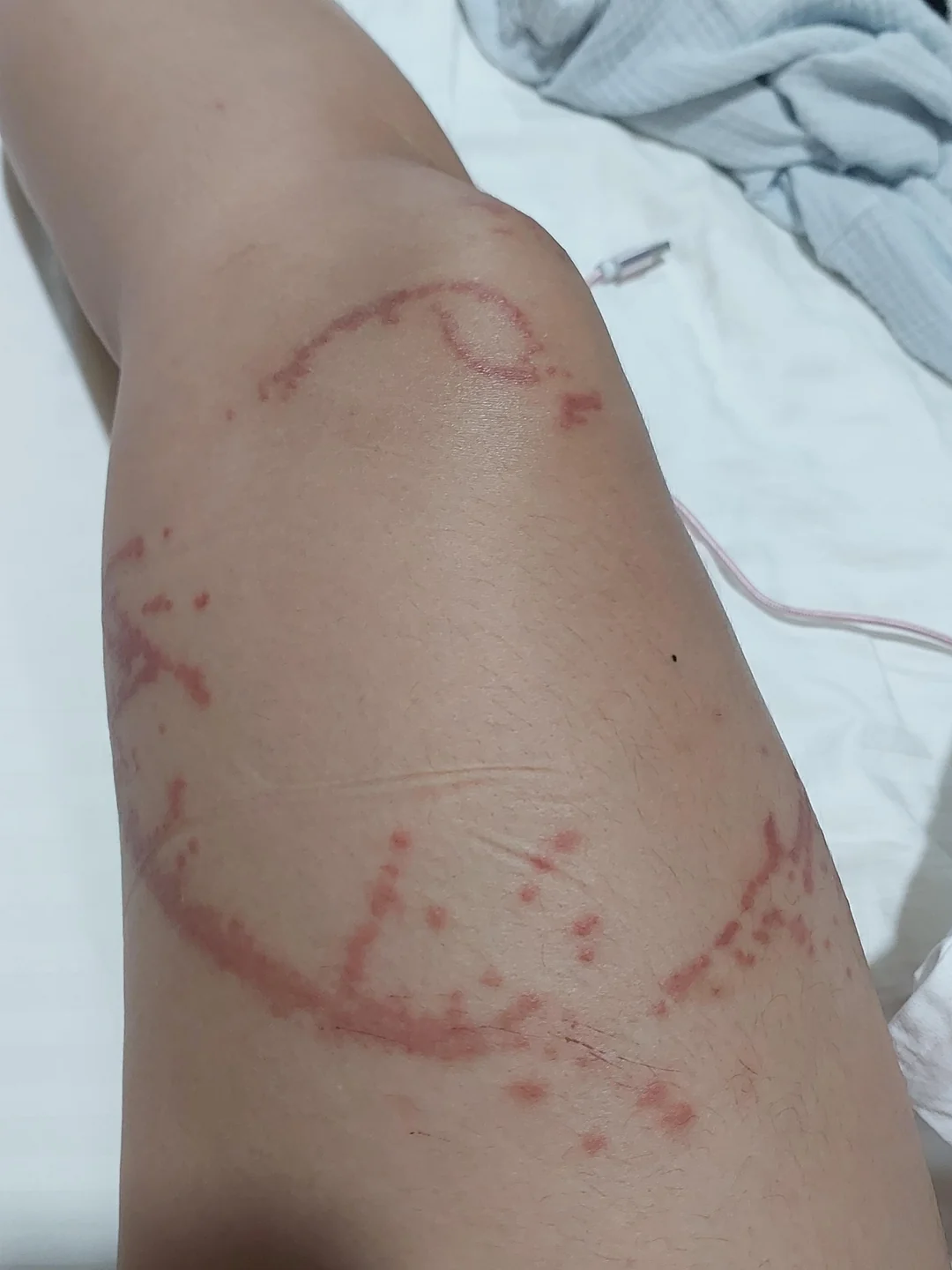 Τσίμπησε μωβ τσούχτρα το παιδί - Οδηγίες από Παιδίατρο και οι πρώτες βοήθειες που πρέπει να δώσεις