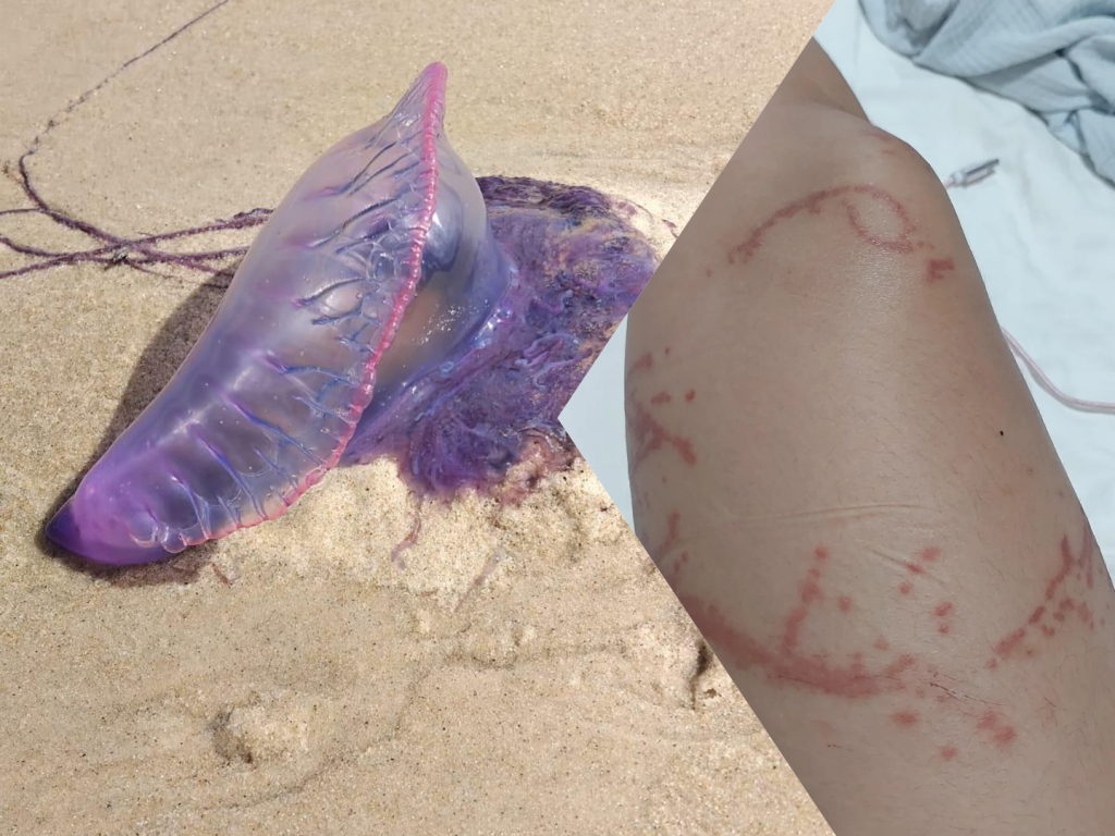 Τσίμπησε μωβ τσούχτρα το παιδί - Οδηγίες από Παιδίατρο και οι πρώτες βοήθειες  που πρέπει να δώσεις