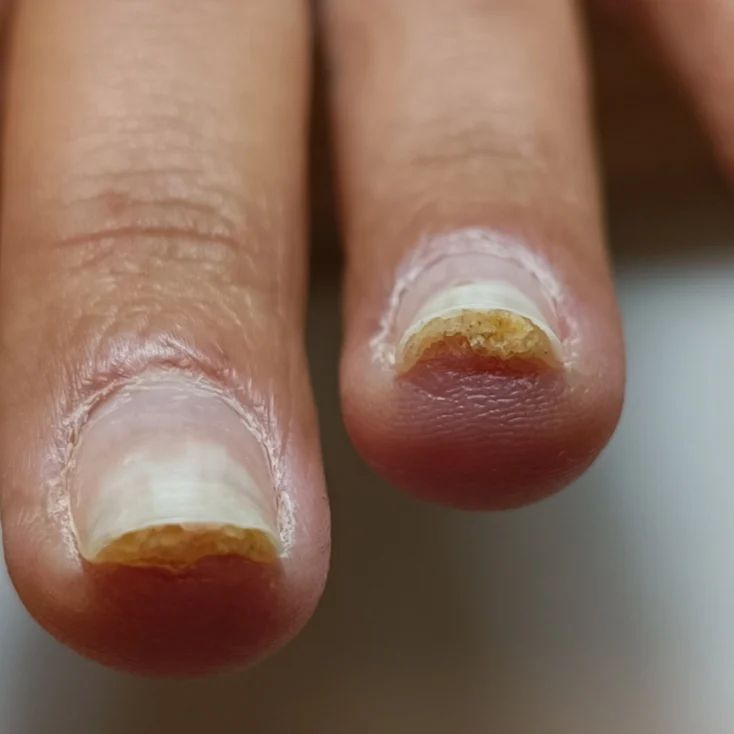 έγκαυμα-στα-νύχια- έγκαυμα-στα-νύχια-