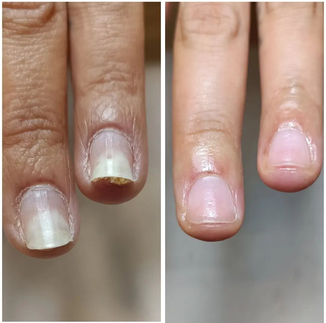 έγκαυμα-στα-νύχια-πριν-μετά- έγκαυμα-στα-νύχια-πριν-μετά-