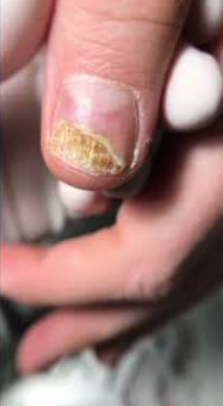 έγκαυμα-στα-νύχια- έγκαυμα-στα-νύχια-