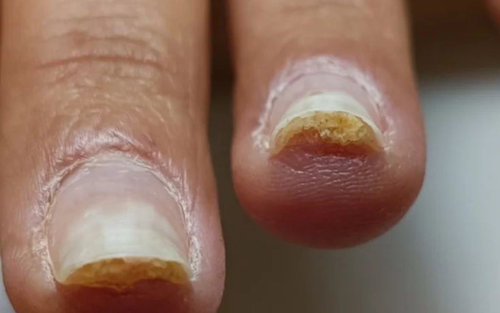 έγκαυμα-στα-νύχια-