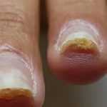 έγκαυμα-στα-νύχια-