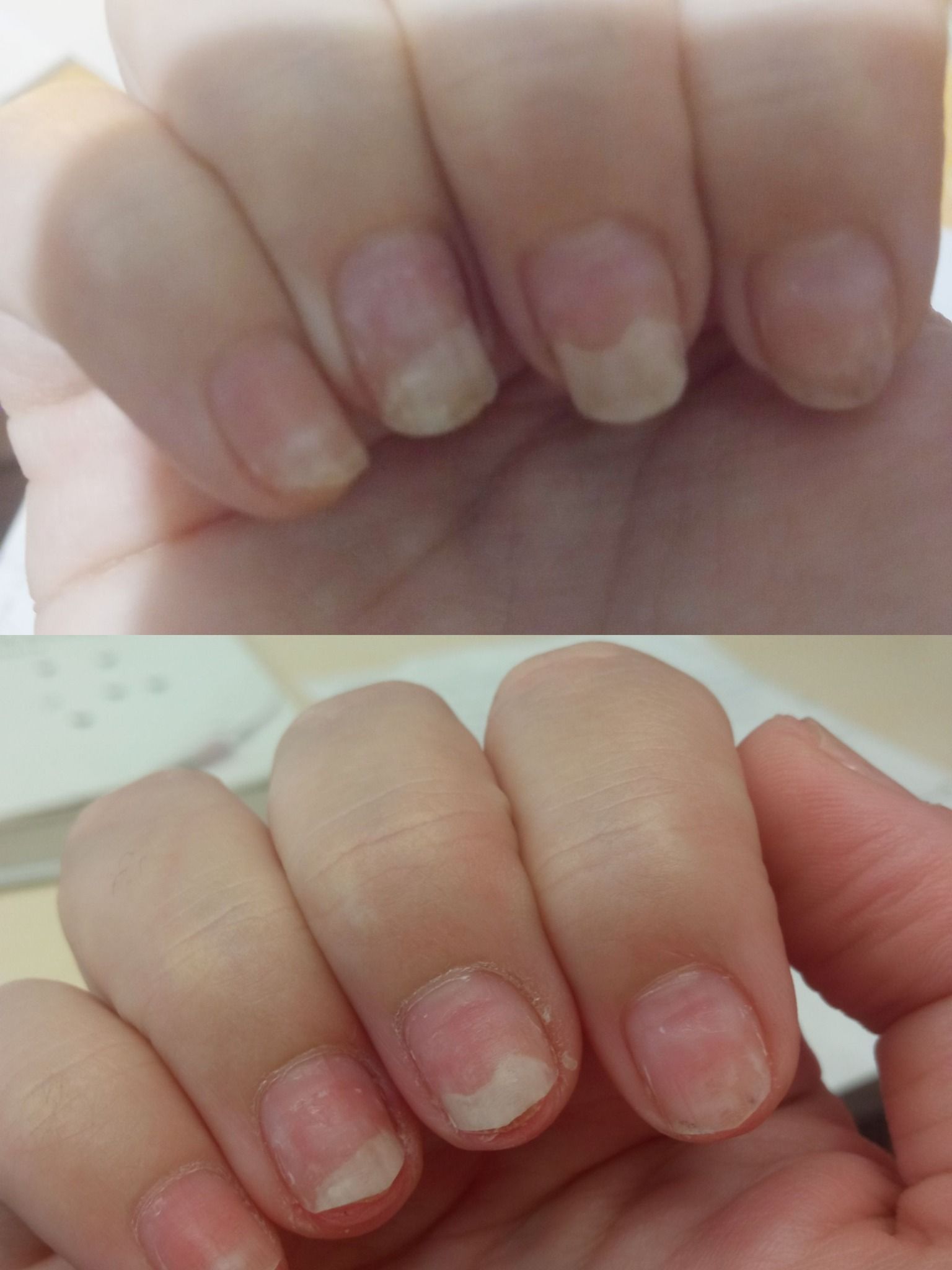 Χημικό και θερμικό έγκαυμα στα νύχια: Τα συμπτώματα και οι συνέπειες από ημιμόνιμο και ακρυλικό μανικιούρ