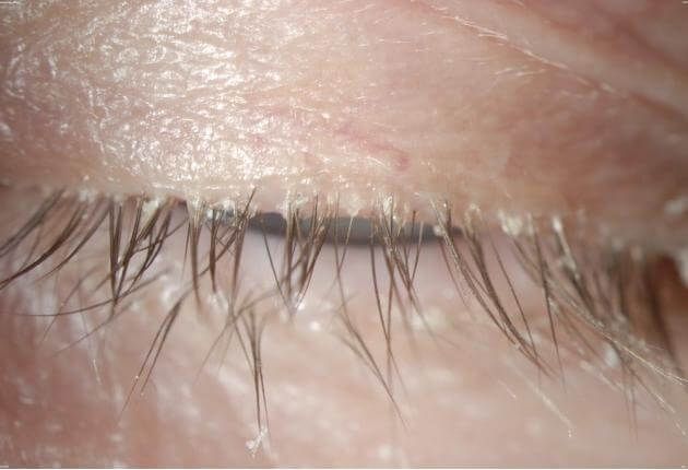 Δεμόδικας: Το ακάρεο που ζει στις βλεφαρίδες και μπορεί να προκαλέσει σοβαρά προβλήματα στα μάτια