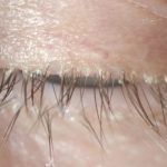 Δεμόδικας: Το ακάρεο που ζει στις βλεφαρίδες και μπορεί να προκαλέσει σοβαρά προβλήματα στα μάτια