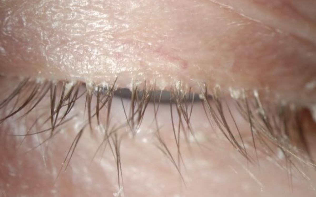 Δεμόδικας: Το ακάρεο που ζει στις βλεφαρίδες και μπορεί να προκαλέσει σοβαρά προβλήματα στα μάτια