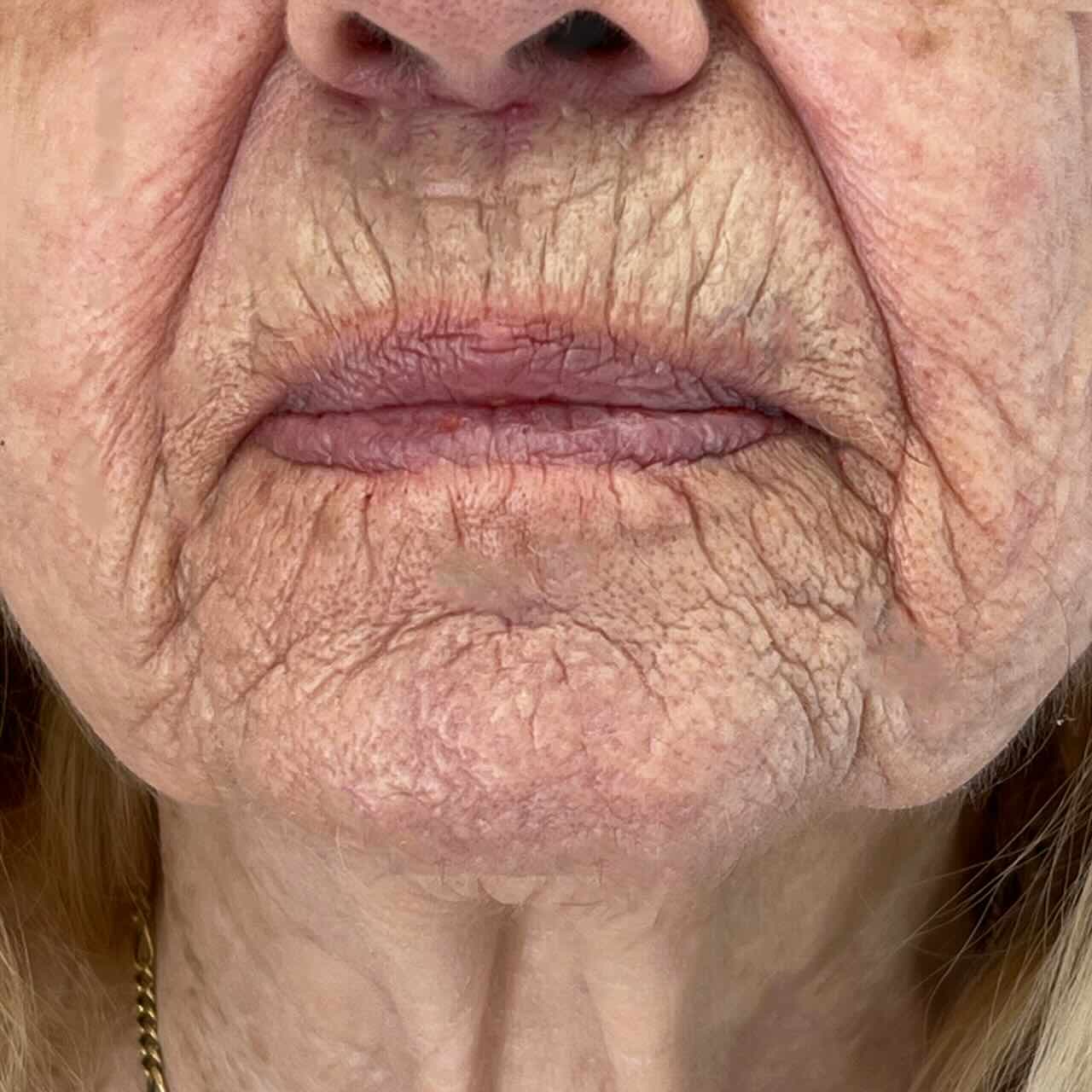 ρυτίδες-στο-πρόσωπο- ρυτίδες-στο-πρόσωπο-