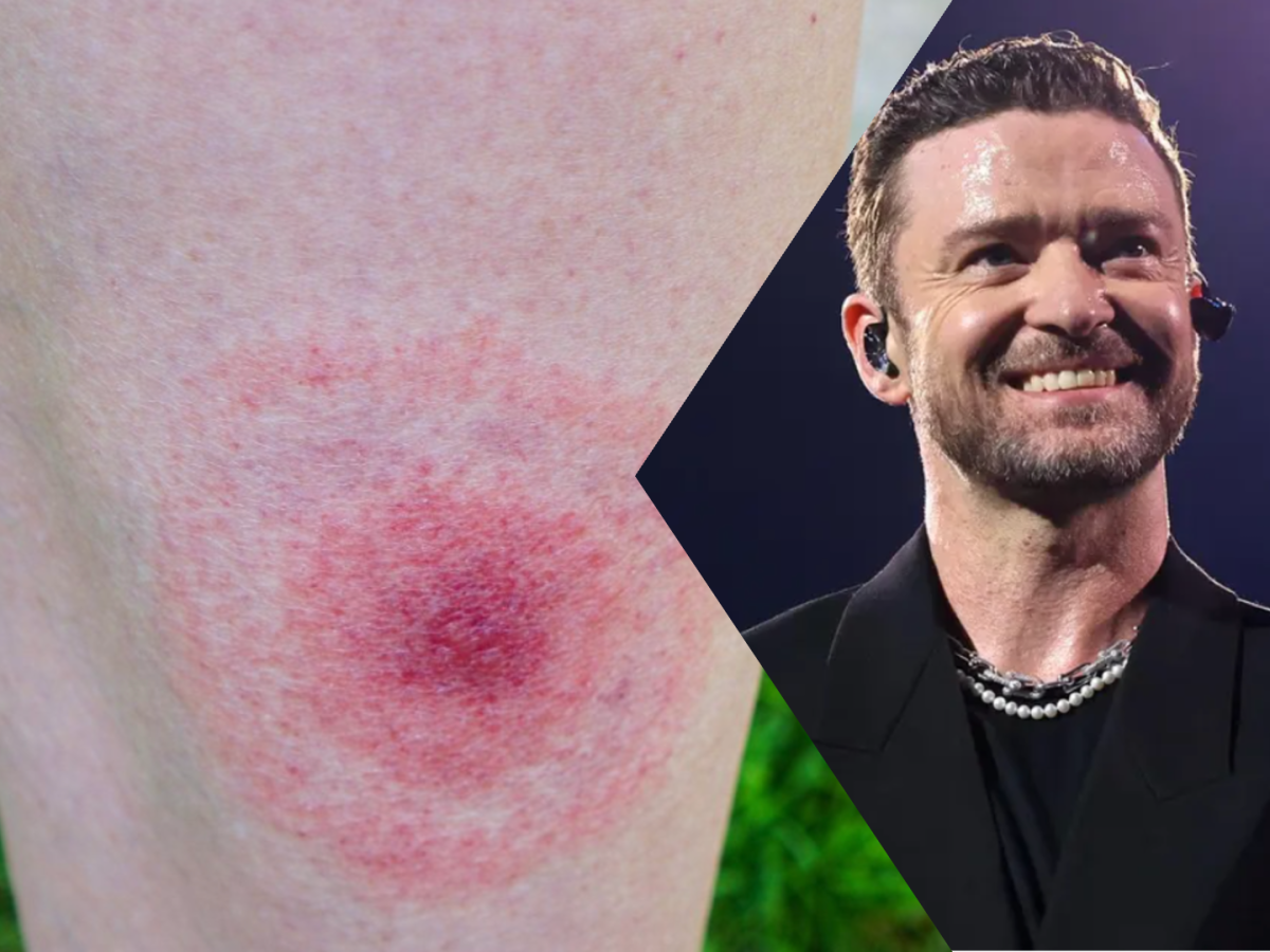 Τι είναι η νόσος του Lyme, με την οποία διαγνώστηκε ο Justin Timberlake;