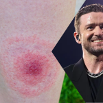 Τι είναι η νόσος του Lyme, με την οποία διαγνώστηκε ο Justin Timberlake;