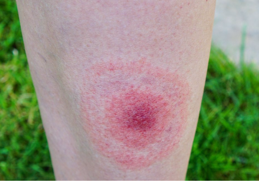 Πόδι-με-δάγκωμα-από-τσιμπούρι