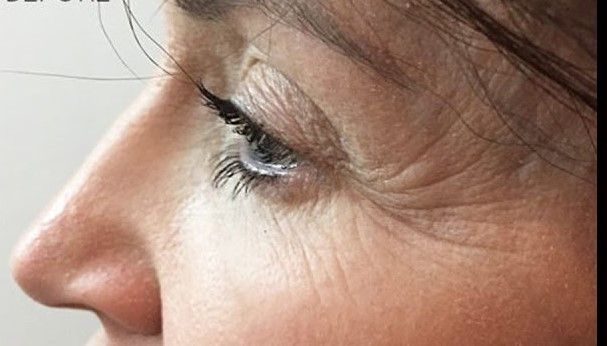 ρυτίδες-στα-μάτια- ρυτίδες-στα-μάτια-