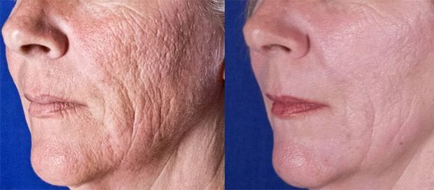 ρυτίδες-πριν-μετά- ρυτίδες-πριν-μετά-