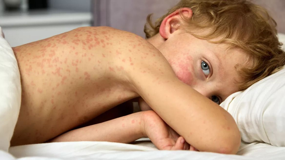 παιδί-με-κοκκύτη-