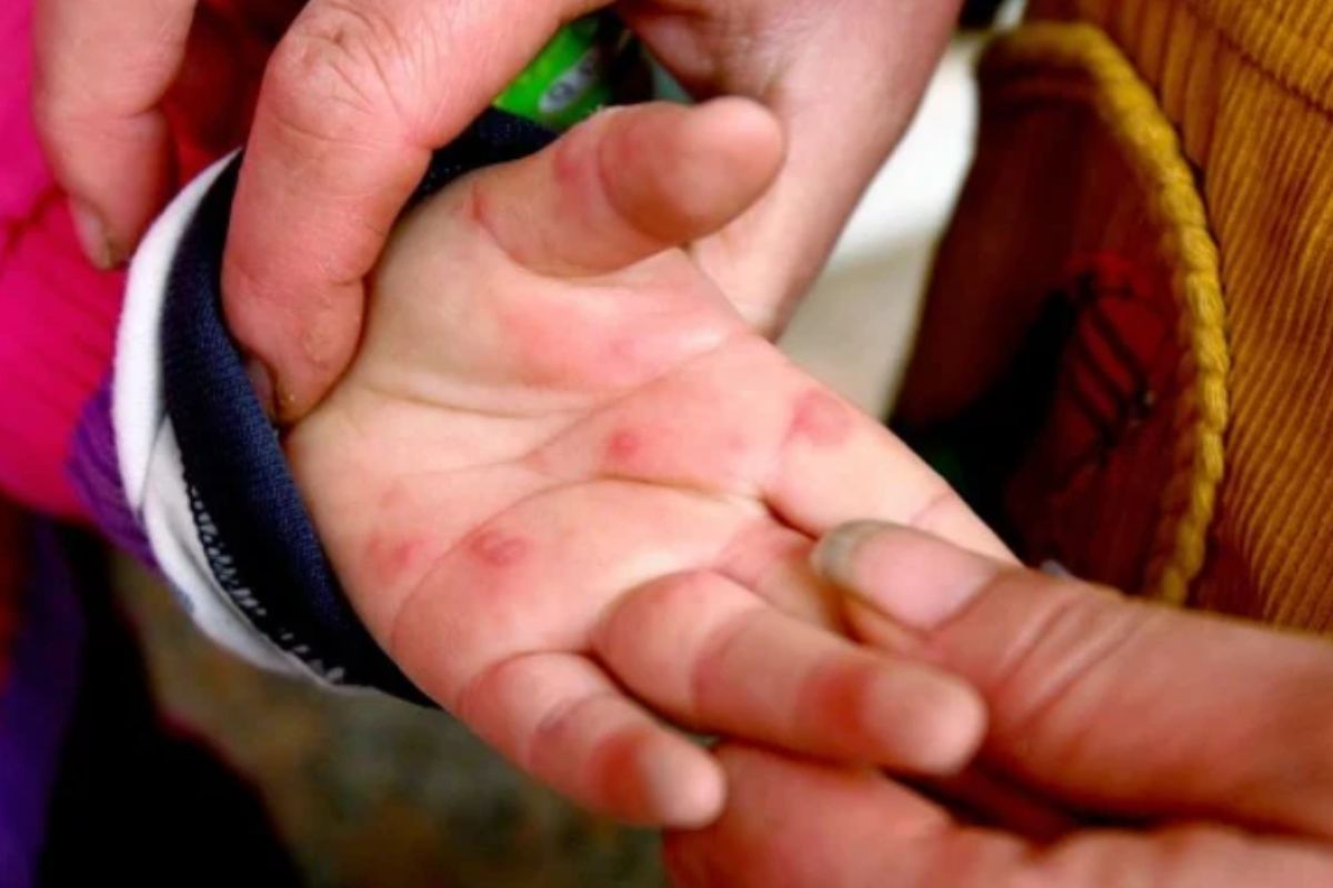 παιδί-με-κοκκύτη-