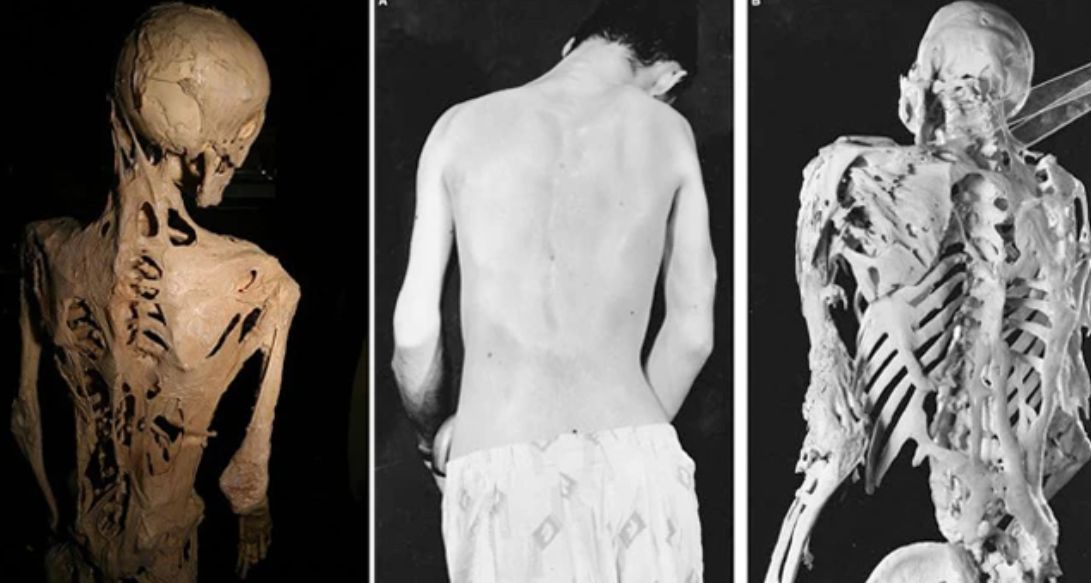 Οι πιο σπάνιες και φονικές ασθένειες για τον άνθρωπο