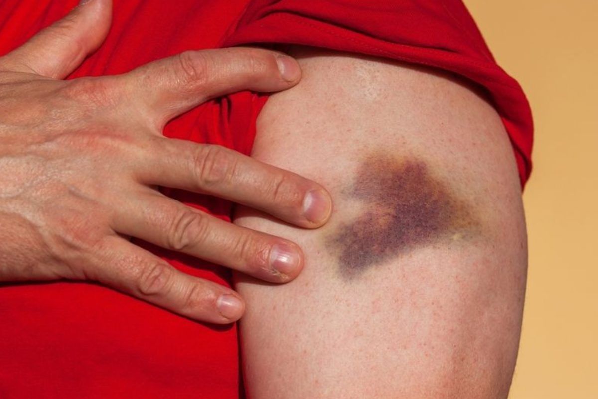 Πανκυτταροπενία-συμπτώματα-μελανιά-