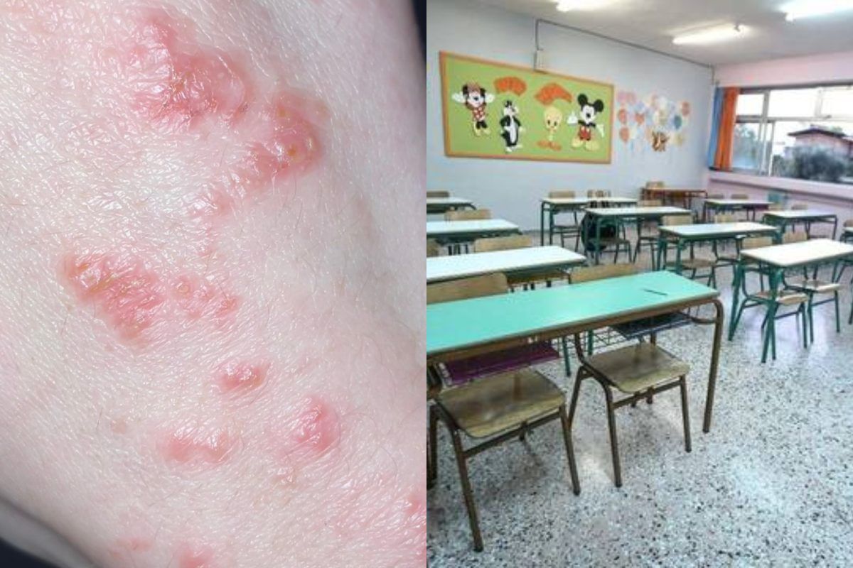 Συναγερμός στα σχολεία: Εντοπίστηκαν κρούσματα ψώρας - Ο ΕΟΔΥ προειδοποιεί