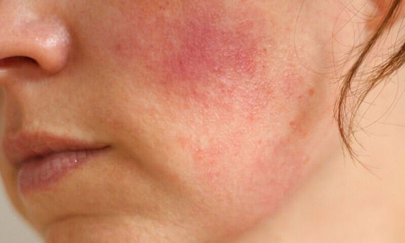 Συστηματικός ερυθηματώδης λύκος: Ποια είναι τα ύπουλα συμπτώματα